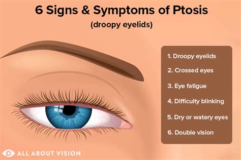 Droopy Eyelid Images - Infoupdate.org