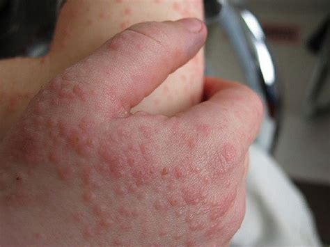 Rash Due to Epstein-Barr Virus Infection: Why and How to Help | MedGuidance