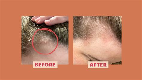 My Scalp Psoriasis Came Out of Nowhere — Here's How I Treated It | Allure