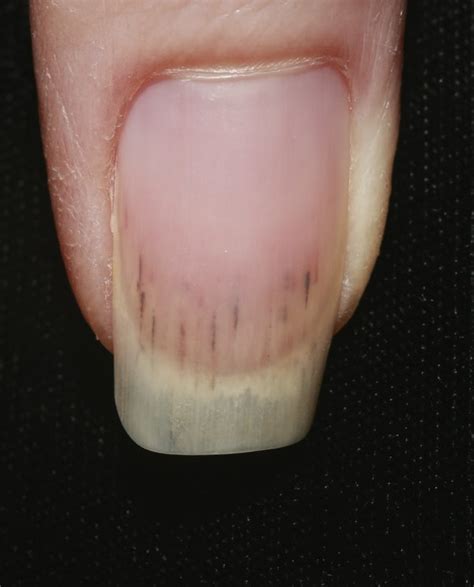 What Causes Black Lines In Fingernails - Design Talk