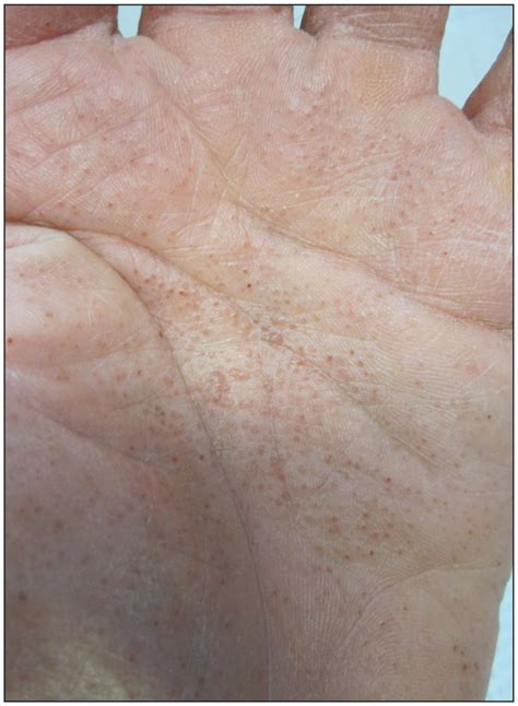 Dyshidrotic Eczema Dyshidrotic Dermatitis