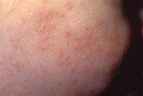 Meningitis Rash On Arm