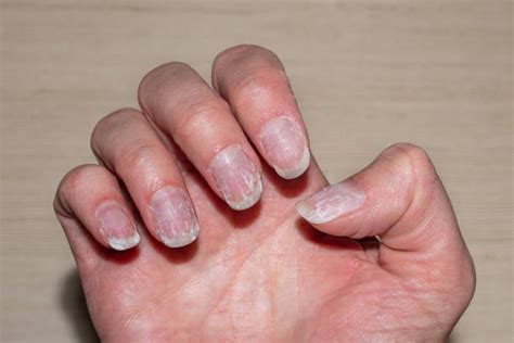 How To Fix Damaged Nails After Fake Nails ( Plastic & gel ) - 5 Steps