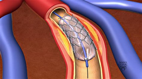 Global Coronary Stents Market $15.7 Billion by 2031