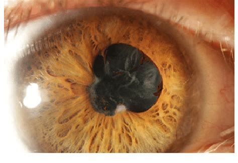 Photograph of the right eye, showing posterior synechiae and cataract ...