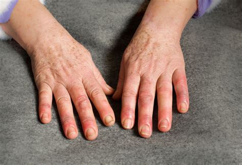 Swollen Fingers: Causes, Treatment, Risks | lupon.gov.ph