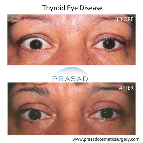 Thyroid Eye Disease Surgery/ Graves Eye Disease Surgery | Dr. Prasad