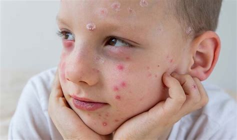 Koplik spots could be symptom of measles - what to look out for ...