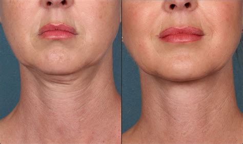 OxyGeneo® TriPollar Face/Neck Tightening | Ottawa Medispa | Orleans