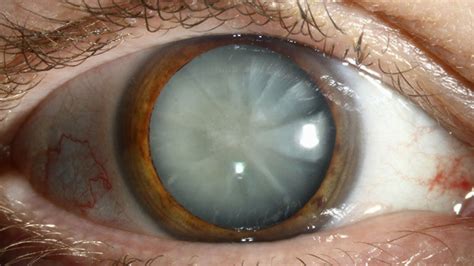 The Disease Of Eye Cataracts