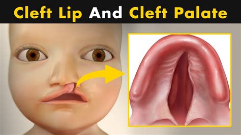 What Causes Cleft Lip And Cleft Palate? | symptoms, Causes And ...