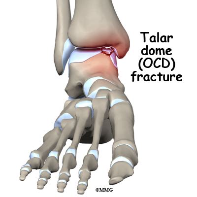 Ankle Osteochondritis (OCD) | drclarkdpm