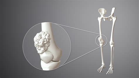 Bone Cancer: Types, Symptoms, Causes and Treatment - Scientific Animations