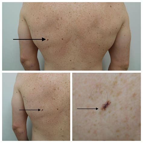 Melanoma Skin Cancer Lesions