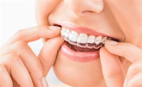 Invisalign Lite in Fort Collins, CO | Milnor Orthodontics