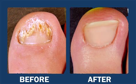 Toenail Fungus Infection – Gather Facts and Get Rid of It ~ Natural ...