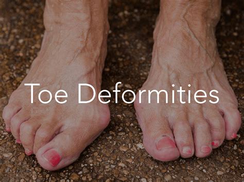 Frisco Toe Deformities | Frisco Foot & Ankle Specialists