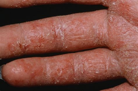 Dermatitis - Contact, Atopic, Perioral, Nummular, Seborrheic, Stasis