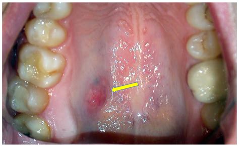 Mouth Cancer Bumps Under Tongue