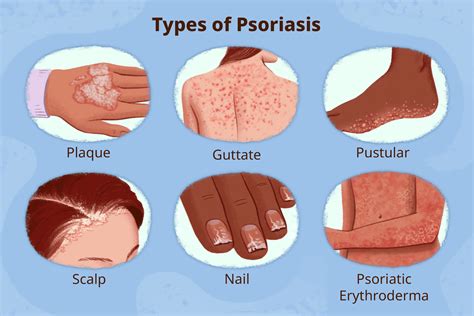 Everything to Know About Psoriasis Types and Symptoms (2023)