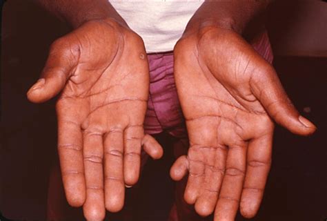 Polydactyly: Symptoms, causes, and treatments