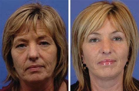 Face improvements without surgery. Sagging jowls and turkey neck can be ...