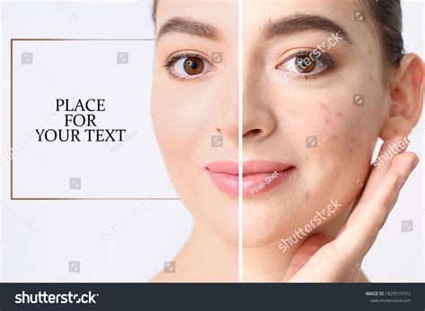 Young Woman Before After Acne Treatment Stock Photo 1829519702 ...