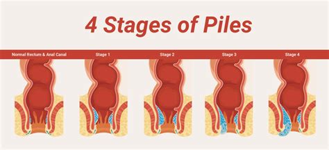 Piles Vs Fissure: Know Difference Between Piles and Fissure