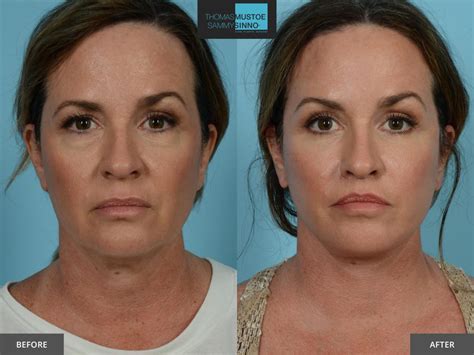 8 Facelift Before-and-After Photos That Prove Just How Natural Today’s ...