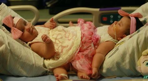 Conjoined Texas twins, Ximena and Scarlett Hernandez-Torres, get set ...