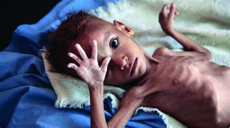 Malnutrition in South Asia – A Critical Reappraisal - Cherrubics