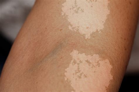 Tinea Versicolor : Overview, Causes, Symptoms, Treatment - illness.com