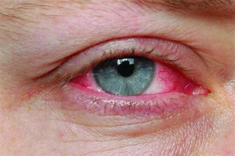 Pharyngoconjunctival Fever