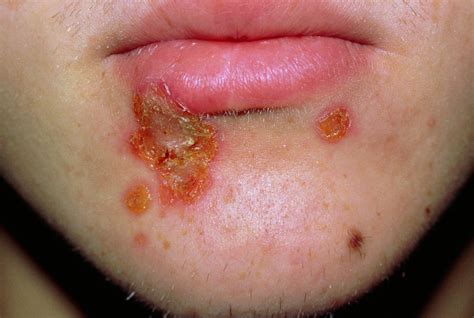 Impetigo Rash Beneath A Man's Lower Lip Photograph by Science Photo Library