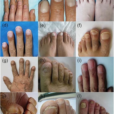 Nail changes in patients with chronic liver disease. (a-c) Terry's ...