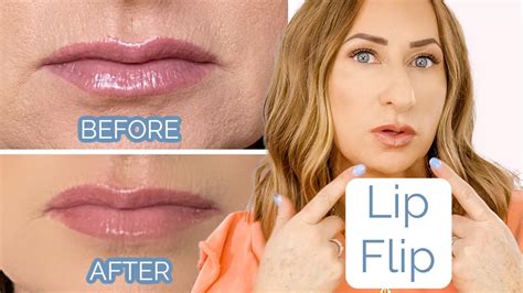 Lip Flip Botox Before And After Photos - Infoupdate.org