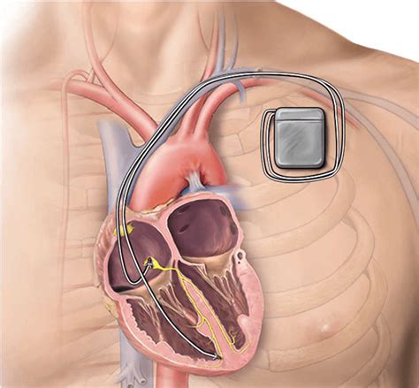 Different types of Defibrillator : Monophasic, Biphasic and Automated ...