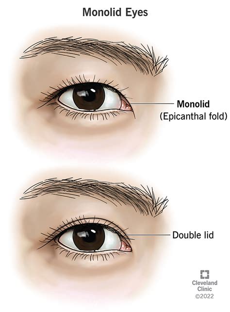 Monolid Eyes: Epicanthal Folds & Causes