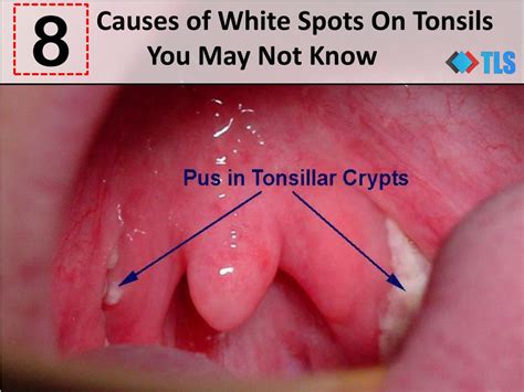 PPT - 8 Causes of White Spots On Tonsils You May Not Know PowerPoint ...