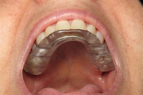 Teeth Grinding or Bruxism — Stephen Johansen Dentistry