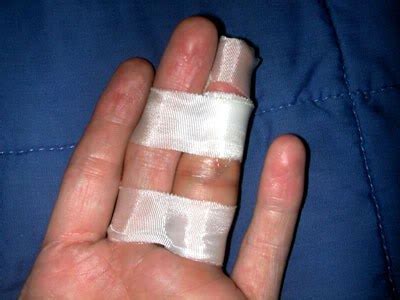 Finger Fracture Treatment | Ladan Hajipour Orthopaedic Surgeon