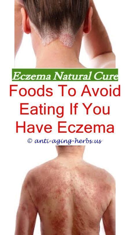 natural remedies for eczema eczema psychological causes - what works ...