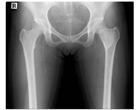 X-ray of the hip, demonstrating ground glass lesion in left neck of ...