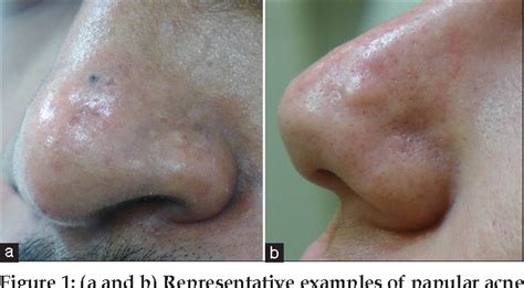 Papular Acne Scars of the Nose and Chin: An Under-recognised Variant of ...