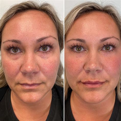 How Long Do Dermal Fillers Last Under Eyes? | Justinboey