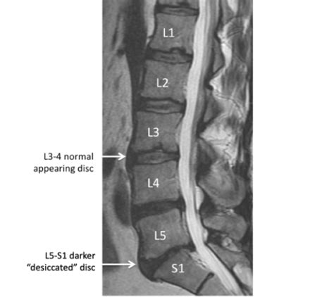 Understanding Your MRI of the Lumbar Spine