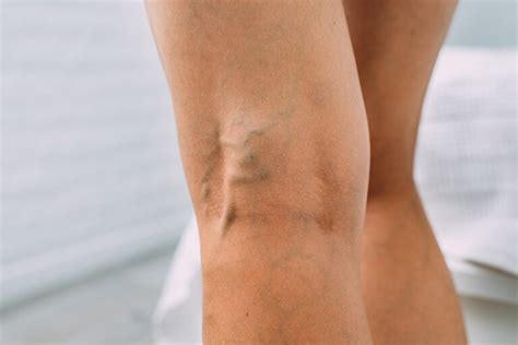 Veins and Broken Blood Vessels – Shapero Dermatology