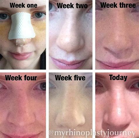 Drinking Alcohol Before Nose Job » Rhinoplasty: Cost, Pics, Reviews, Q&A