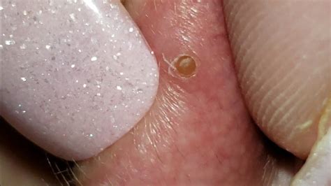 New Blackhead Popping Videos 2024 - Joana Lyndell