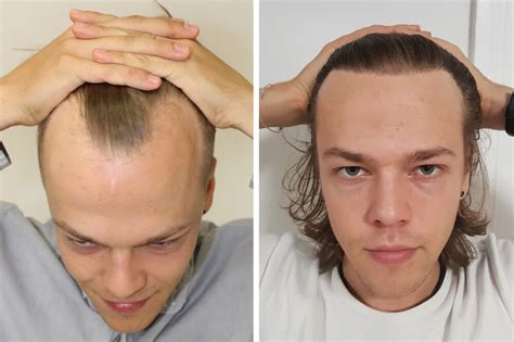 Greffes de cheveux pour traiter calvitie golfes et calvitie vertex ...